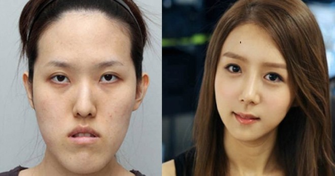 19 előtte és utána fotó, koreai plasztikai sebészeti beavatkozásokról